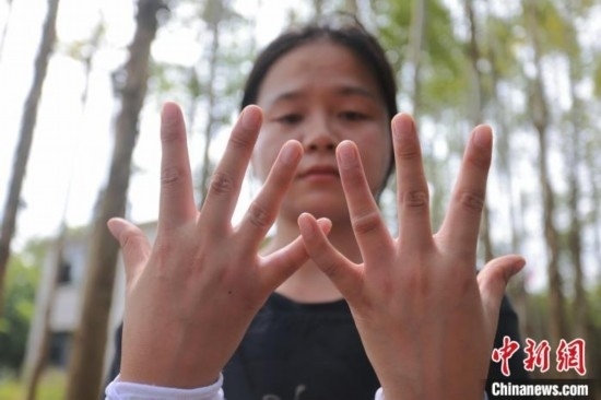 吳素英展示被蜜蜂蜇過的雙手。湯曉逵 攝