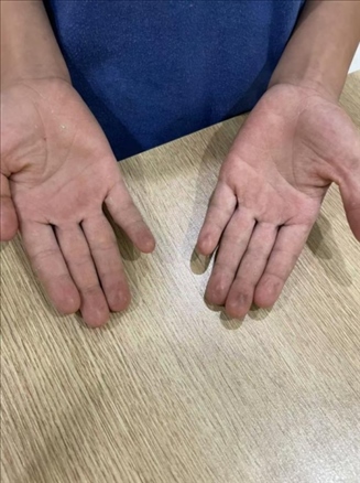 9歲小學(xué)生長期拍煙卡，手部粗糙長繭。受訪者供圖