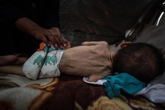 這是5月28日在加沙城西部一處臨時安置點拍攝的一名營養(yǎng)不良的嬰兒。新華社發(fā)（馬哈茂德·扎基攝）